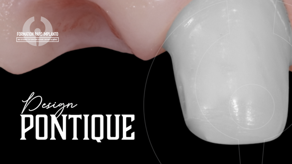 Design pontique: anatomie, esthétique et intégration tissulaire