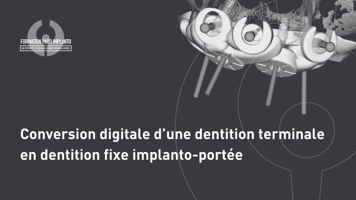 Conversion digitale d'une dentition terminale en dentition fixe implanto-portée